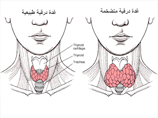 علاج التهاب الغدة الدرقية - أعراض التهاب الغدة الدرقية 12586 1