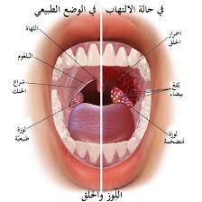 علاج لاحتقان الحلق - أعراض احتقان الحلق 12423