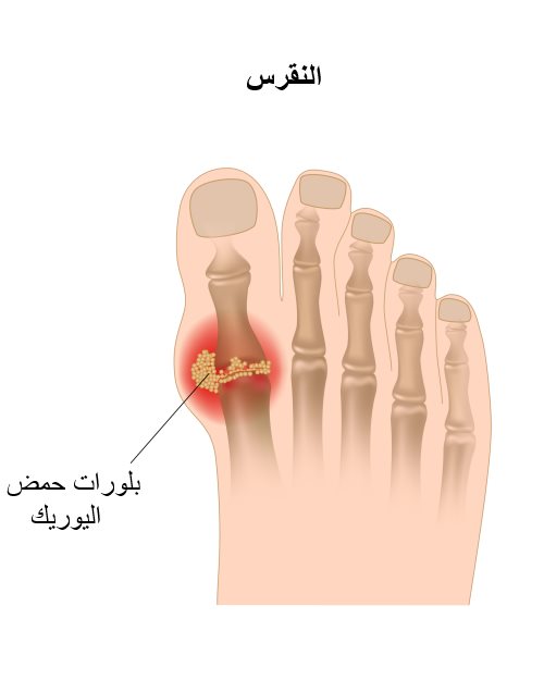 ما هو مرض النقرس , اسباب واعراض مرض النقرس