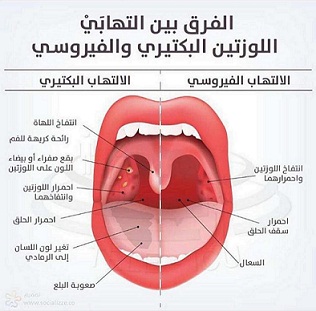 علاج التهاب الحلق , اسرع علاج لالتهاب الحلق