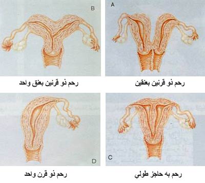 الرحم ذو القرنين والجماع - أعراض الرحم ذو القرنين 12228