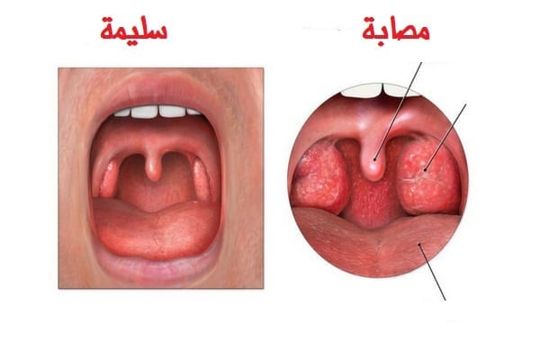 علاج الاحتقان عند الاطفال الرضع 12659 1