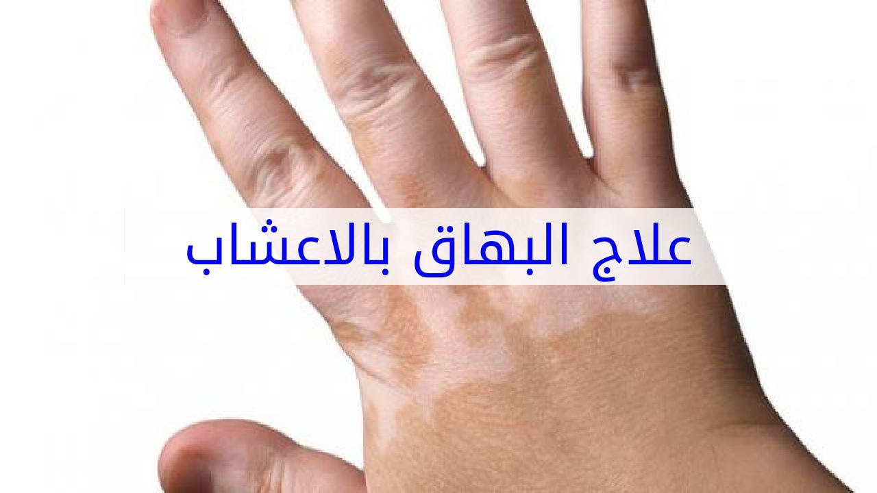 علاج البرص - ماهى الاسباب التي تؤدي الى حدوث مرض البهاق 6556 8