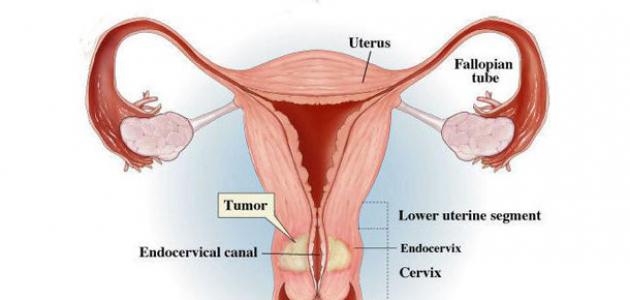 علاج سرطان الرحم 12483 3