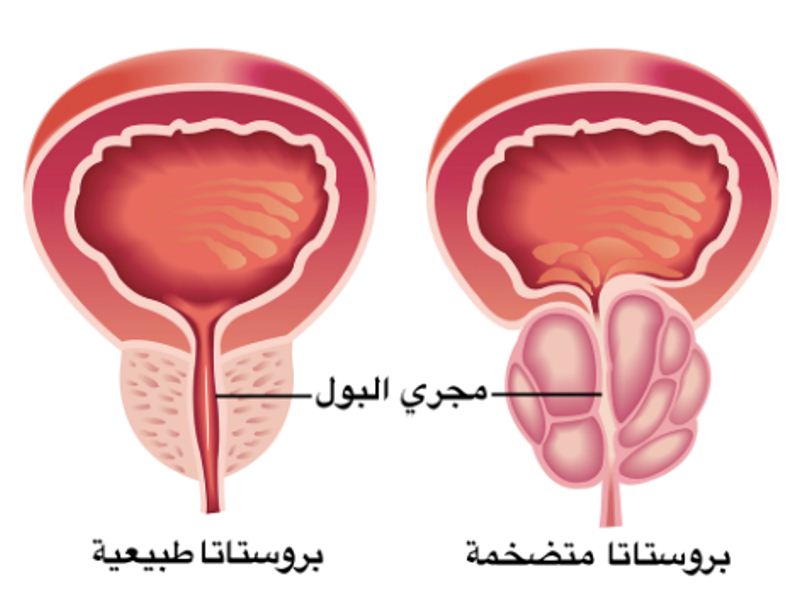 اعراض البروستاتا - الاعراض المصاحبة للبروستاتا 3758 2