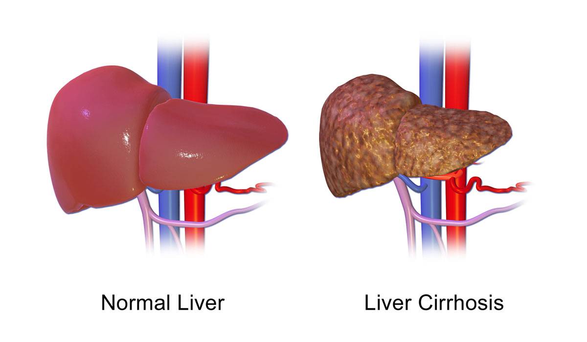 علاج تليف الكبد-ماهى اسباب تليف الكبد 6510 2