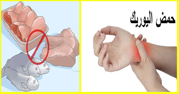 مرض النقرس - ماهو النقرس واعراضه 3847 1