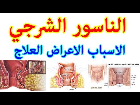 ما هو الناسور - اعراض مرض الناسور 1212