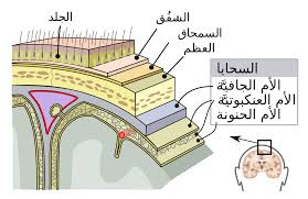 مرض السحايا , تعرفي علي مرض السحايا