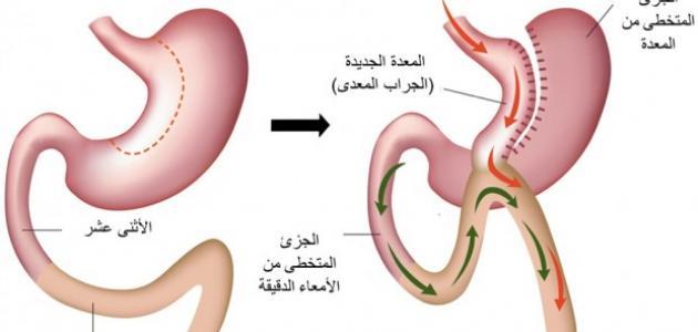 عملية غسيل المعدة - تعرف ع خطوات عمليه غسيل المعده 13101 1