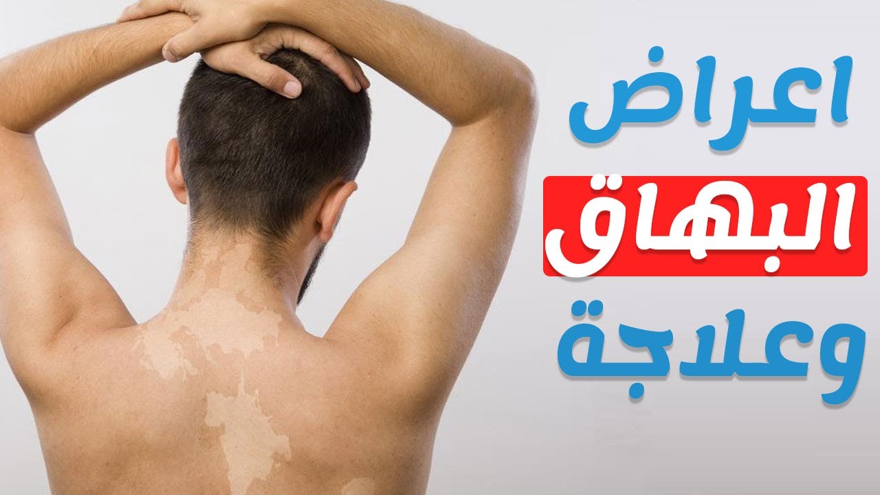 علاج البرص - ماهى الاسباب التي تؤدي الى حدوث مرض البهاق 6556 10