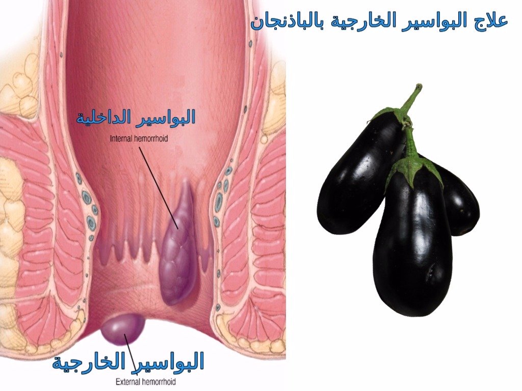 علاج البواسير - ماهى طرق علاج البواسير 3167 1