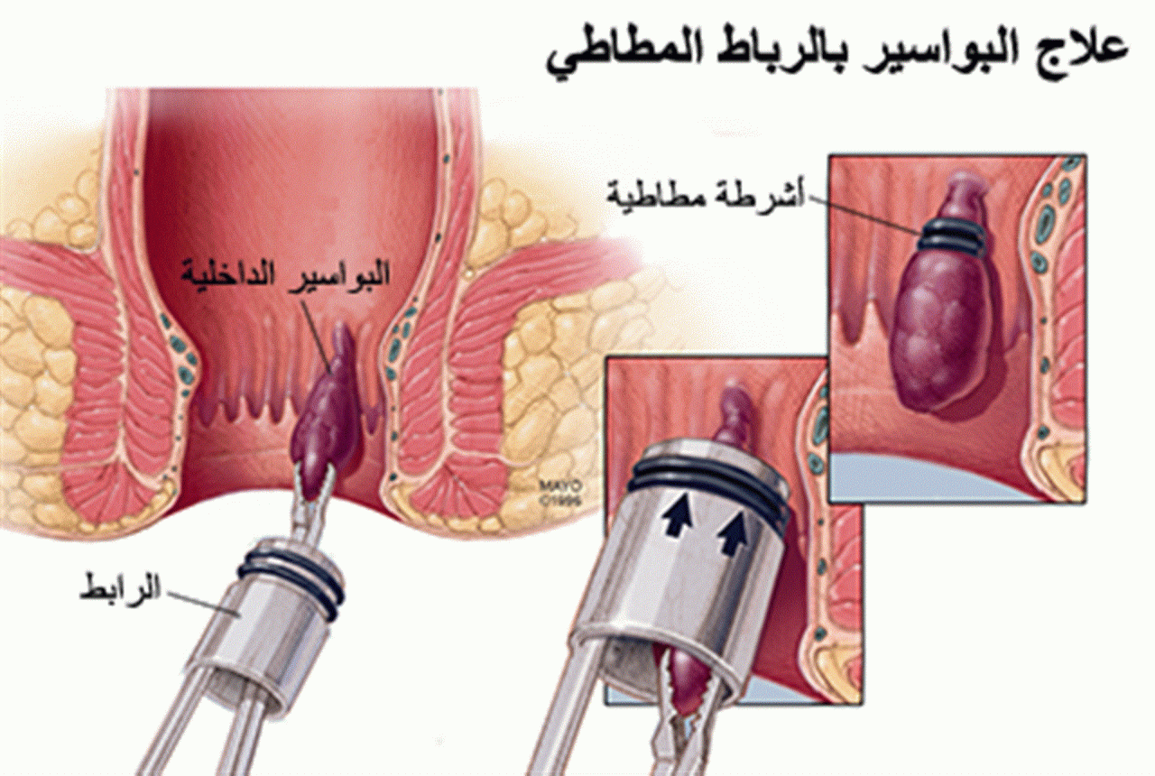 علاج البواسير - ماهى طرق علاج البواسير 3167