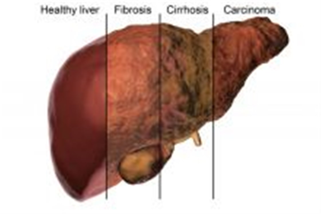 علاج تليف الكبد-ماهى اسباب تليف الكبد 6510