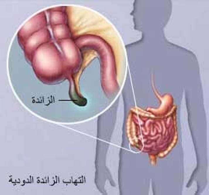 اعراض الزائدة الدودية - كيف اعرف اني مصاب بالزائدة الدودية 4897 1