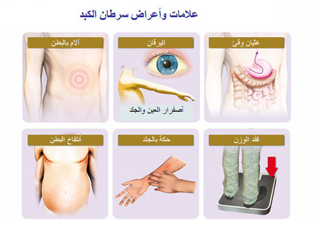 اعراض مرض السرطان , المرض الذي يسمي بالخبيث