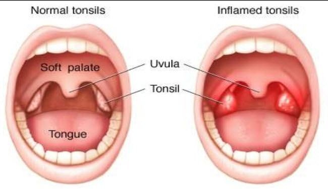 علاج التهاب اللوزتين - افضل علاج لالتهاب اللوزتين 2849 3