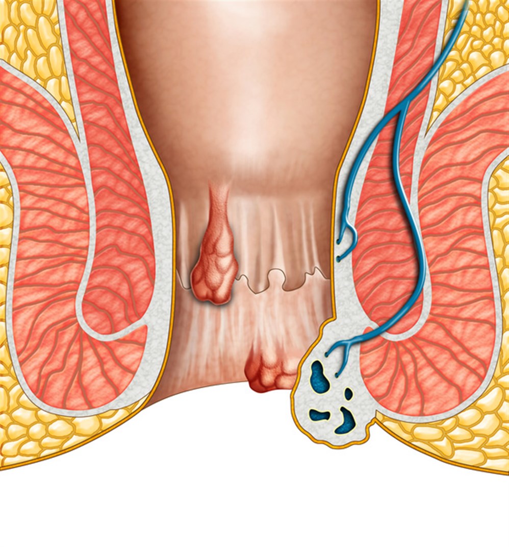 علاج البواسير - ماهى طرق علاج البواسير 3167 11