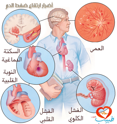 اعراض ارتفاع الضغط - ادرك ضغطك وعالجه 6327 6