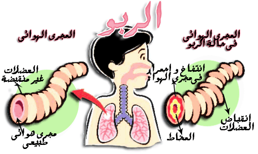 مرض الربو - تعرف على مرض الربو 1082