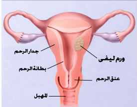 علاج سرطان الرحم 12483 1