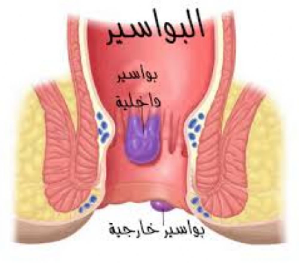 علاج الناسور - كيفية علاج الناسور 3831 1