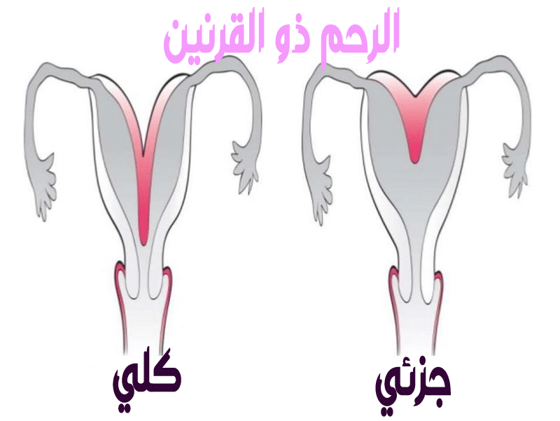 الرحم ذو القرنين والجماع - أعراض الرحم ذو القرنين 12228 1