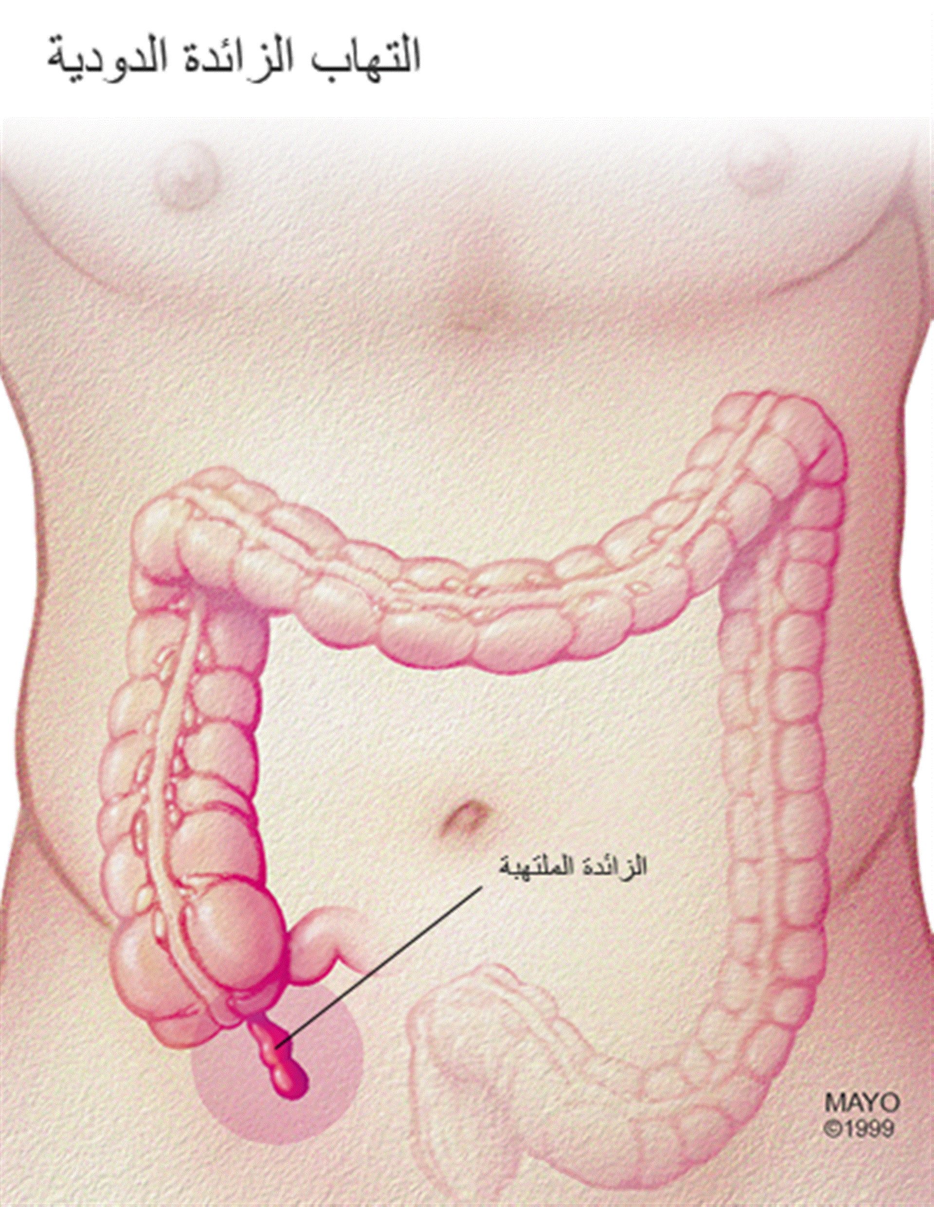 اعراض الزائدة الدودية - كيف اعرف اني مصاب بالزائدة الدودية 4897