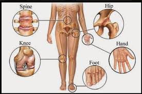 علاج الروماتيزم - طريقه علاج الروماتيزم 1707 1