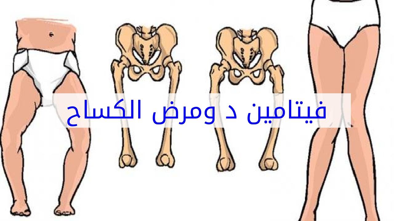 مرض الكساح , علامات واعراض مرض الكساح