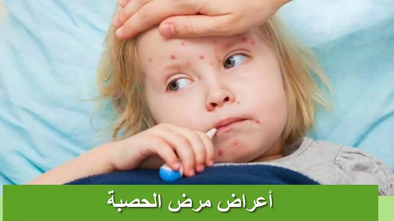 مرض الحصبة , اعراض واساب مرض الحصبه