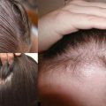 3408 3 تكثيف الشعر الخفيف , وصفة طبيعية لحل مشكلة تساقط الشعر ناجح هبار