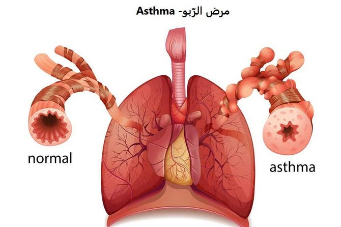 مرض الربو , تعرف على مرض الربو