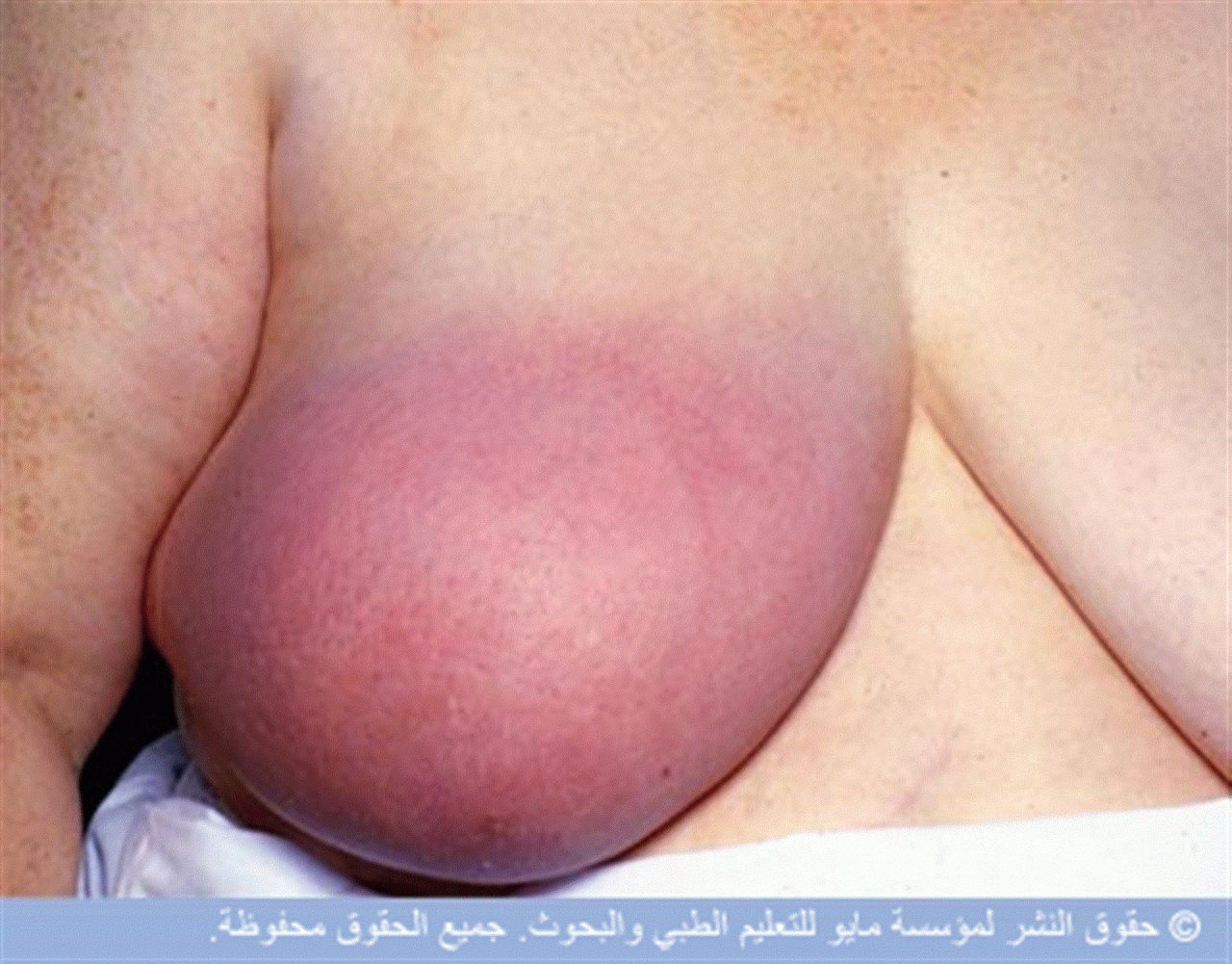 опухла одна грудь у девочек (119) фото